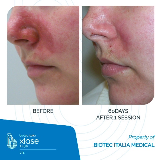 Xlase Plus Medical Laser in Wien 1010