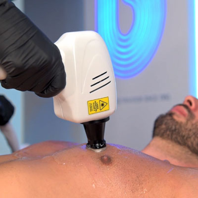 Laser Haarentfernung Behandlung - AlexPro Technologie