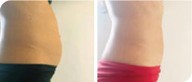 Bauch und Taille vorher und nach 3 LYSIWAVE Sitzungen