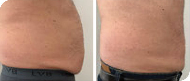 Bauch straffen vorher und nach 4 LYSIWAVE Sitzungen